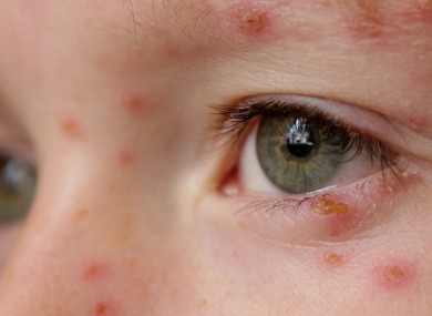 File photo: A child with chickenpox